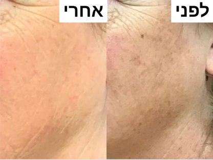 סבון סופרפוד לפנים - לחיסול הפיגמנטציה