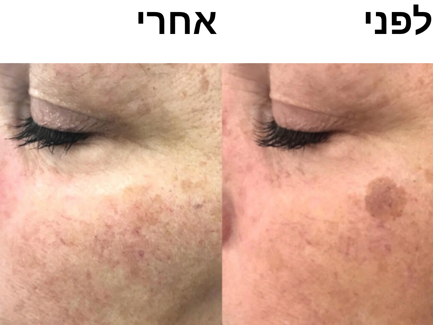 סבון סופרפוד לפנים - לחיסול הפיגמנטציה