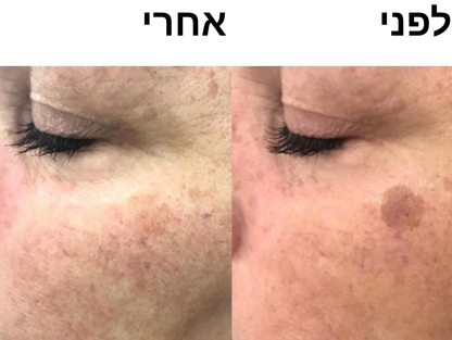 סבון סופרפוד לפנים - לחיסול הפיגמנטציה