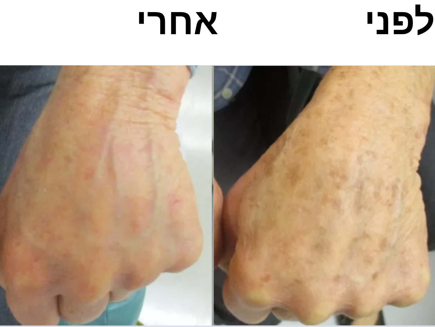 סבון סופרפוד לפנים - לחיסול הפיגמנטציה