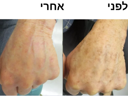 סבון סופרפוד לפנים - לחיסול הפיגמנטציה